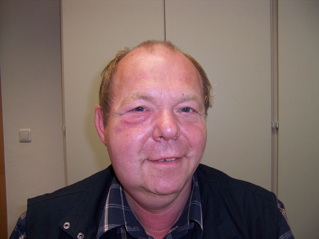 k-Bienenstiche Gesicht.jpg