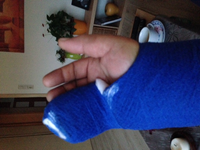 Eingegipster Ringfinger rechts