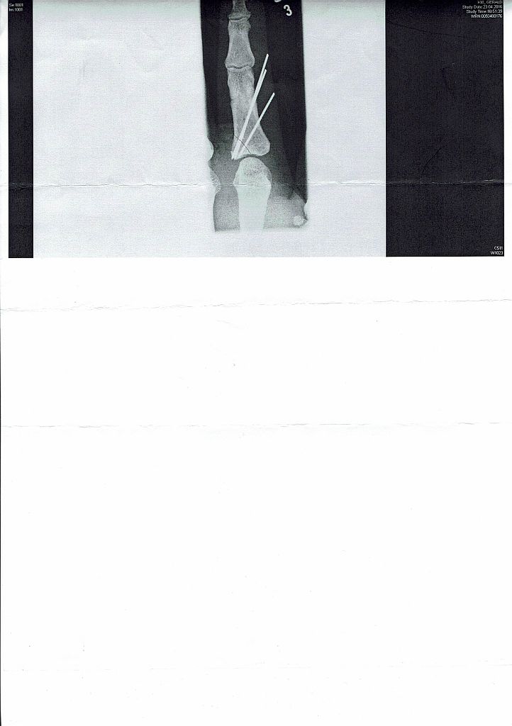 Zeigefinger naggisch